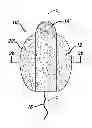 Fig. 01 - Fluid management device with fluid transport element for use within a body