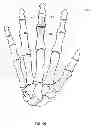 Fig. 17 - System and Method for Bone Fixation