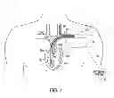 Fig. 02 - Managing cross therapy delivery in a multiple therapy implantable device