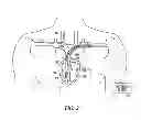 Fig. 03 - Managing cross therapy delivery in a multiple therapy implantable device