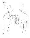 Fig. 02 - Fault tolerant pacing