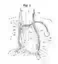 Fig. 03 - System and method to modulate phrenic nerve to prevent sleep apnea