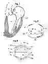 Fig. 02 - Anchoring device for replacing or repairing a heart valve
