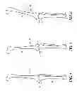 Fig. 04 - System and method for pre-operatively determining desired alignment of a knee joint
