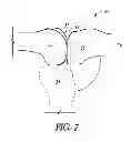 Fig. 05 - System and method for pre-operatively determining desired alignment of a knee joint