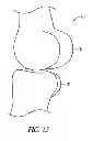 Fig. 10 - System and method for pre-operatively determining desired alignment of a knee joint