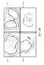 Fig. 12 - System and method for pre-operatively determining desired alignment of a knee joint