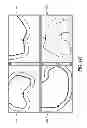 Fig. 13 - System and method for pre-operatively determining desired alignment of a knee joint