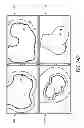 Fig. 14 - System and method for pre-operatively determining desired alignment of a knee joint