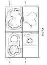 Fig. 15 - System and method for pre-operatively determining desired alignment of a knee joint