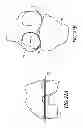 Fig. 23 - System and method for pre-operatively determining desired alignment of a knee joint