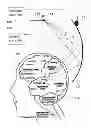 Fig. 01 - Electromagnetic Deep Tissue Excitation
