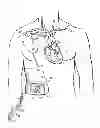 Fig. 01 - Methods, devices and systems for counterpulsation of blood flow to and from the circulatory system