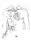 Fig. 02 - Methods, devices and systems for counterpulsation of blood flow to and from the circulatory system