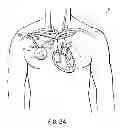 Fig. 03 - Methods, devices and systems for counterpulsation of blood flow to and from the circulatory system