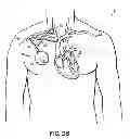 Fig. 04 - Methods, devices and systems for counterpulsation of blood flow to and from the circulatory system