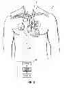Fig. 07 - Methods, devices and systems for counterpulsation of blood flow to and from the circulatory system