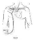 Fig. 08 - Methods, devices and systems for counterpulsation of blood flow to and from the circulatory system
