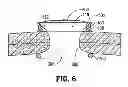 Fig. 09 - WOUND PROTECTOR WITH REINFORCED RING