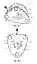 Fig. 44 - Systems and methods for radiographically identifying an access port