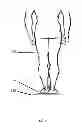 Fig. 02 - System, method and apparatus for determining the thickness of orthotics needed to correct for differences in leg length