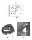 Fig. 02 - Dry eye treatment apparatus and methods