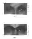 Fig. 06 - Dry eye treatment apparatus and methods