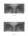 Fig. 07 - Dry eye treatment apparatus and methods