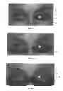 Fig. 08 - Dry eye treatment apparatus and methods