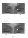 Fig. 09 - Dry eye treatment apparatus and methods
