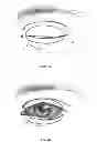 Fig. 03 - Dry eye treatment systems