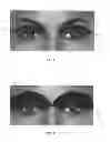 Fig. 06 - Dry eye treatment systems