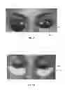Fig. 10 - Dry eye treatment systems