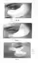 Fig. 11 - Dry eye treatment systems