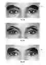 Fig. 16 - Dry eye treatment systems