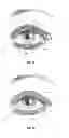 Fig. 21 - Dry eye treatment systems