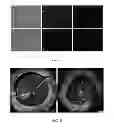 Fig. 07 - Devices, systems, and methods for excavating cancer cells