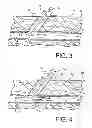 Fig. 03 - Vascular sealing device and method using clot enhancing balloon and electric field generation