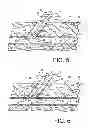 Fig. 04 - Vascular sealing device and method using clot enhancing balloon and electric field generation