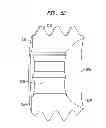 Fig. 15 - Fixation system, an intramedullary fixation assembly and method of use