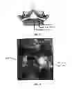 Fig. 04 - DEVICES, SYSTEMS AND METHODS FOR TISSUE MODIFICATION