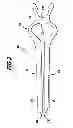 Fig. 03 - Surgical clip