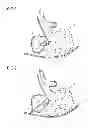 Fig. 02 - METHOD FOR TREATMENT OF EMPHYSEMA