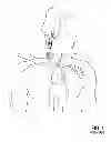 Fig. 02 - Transvascular retrograde access devices