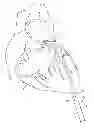 Fig. 01 - Hemostasis valve and guidewire pacing system