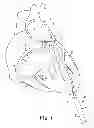 Fig. 02 - Hemostasis valve and guidewire pacing system