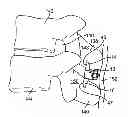 Fig. 01 - Interspinous spacer