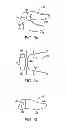 Fig. 07 - Interspinous spacer