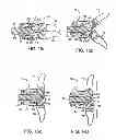 Fig. 22 - Interspinous spacer