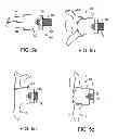 Fig. 10 - Interspinous spacer